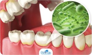 مهم‌ترین علائم عفونت دندان، درد، تغییر رنگ دندان و بوی بد دهان است. دندانپزشکان پوسیدگی دندان را از شایع‌ترین علل عفونت دندان می‌دانند. در این حالت باکتری‌ها از طریق سوراخ‌های دندان راهی برای نفوذ به درون آنها پیدا می‌کنند